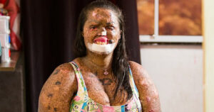 Woman With Rare Skin Condition Finds Confidence, Happiness, and True Love