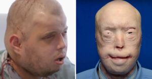 A Firefighter Survived Severe Burns—See His Remarkable Transformation 11 Years Later