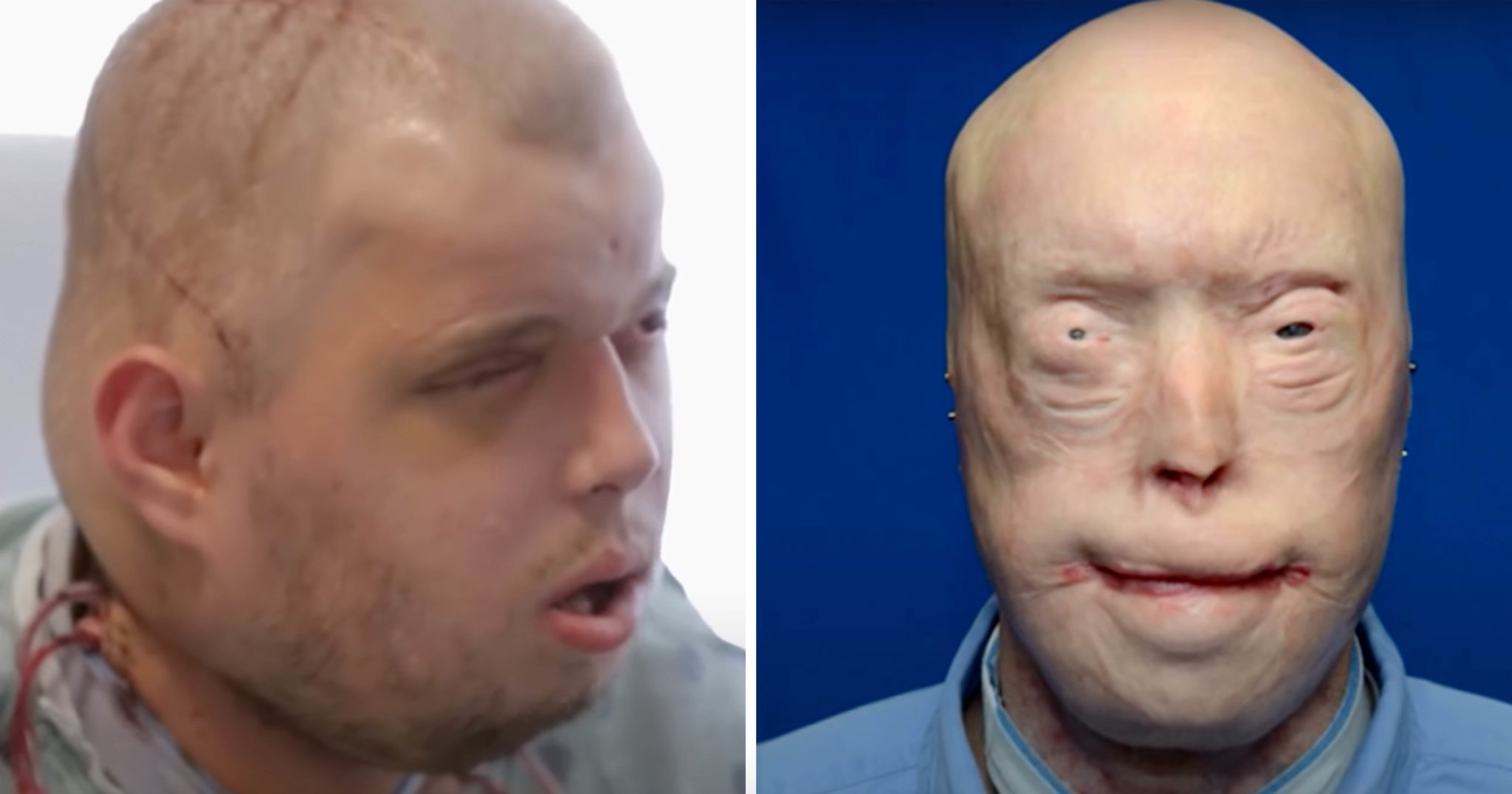 A Firefighter Survived Severe Burns—See His Remarkable Transformation 11 Years Later
